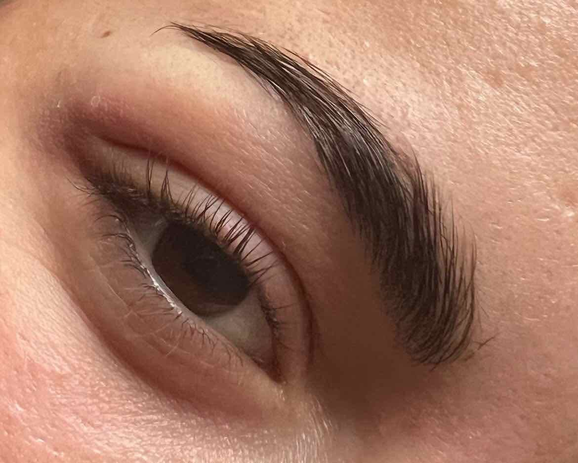 Browlift