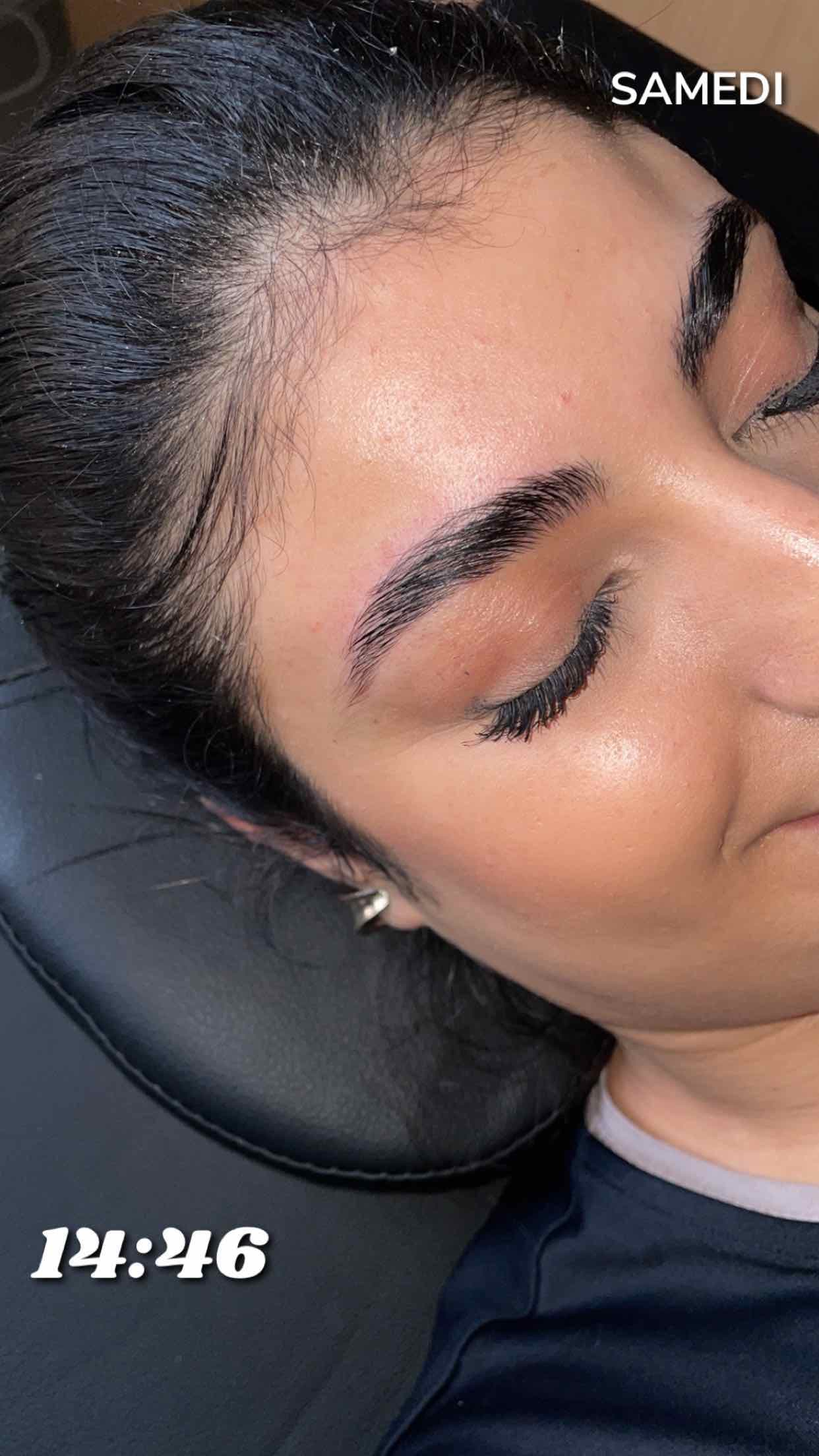 Browlift