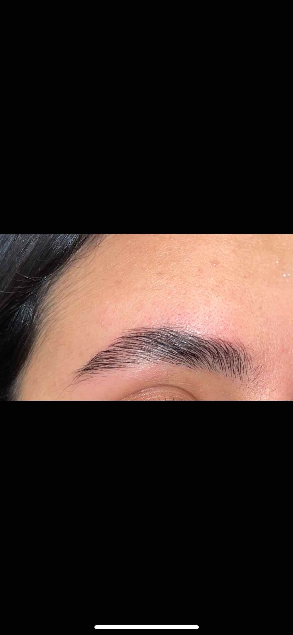 Browlift